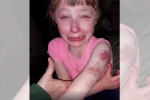 Lilly, bite marks, 10 year old special needs child brutally bitten on arm while returning home in school bus, Special needs child