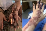 henna tattoo side effects, allergic reaction to henna hair dye, henna tattoo cause aussie woman to almost lose her hand, Phenyl