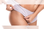 white stretch marks weight loss, stretch marks are beautiful, difference between red and white stretch marks explained and it s natural to have them, Puberty