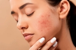 pimples, acne, 10 ways to get rid of pimples at home, Skincare