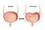 Overactive Bladder latest, Overactive Bladder, here are some warning signs of an overactive bladder, Overactive bladder